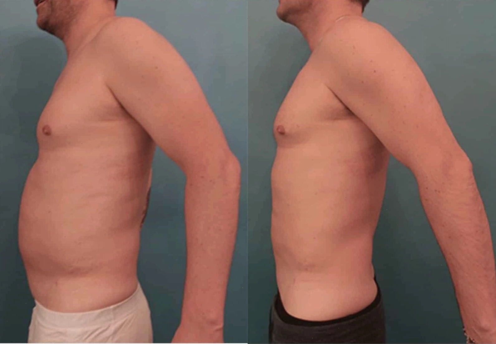 Thiết bị body contouring sử dụng công nghệ sóng siêu âm