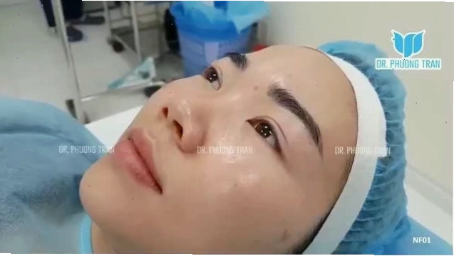 Toàn cảnh một ca nâng mũi