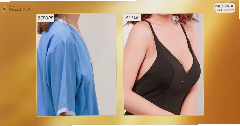 Trước và sau khi nâng ngực an toàn ở Medika