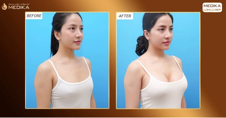 Trước và sau khi nâng ngực bằng túi xốp Polytech