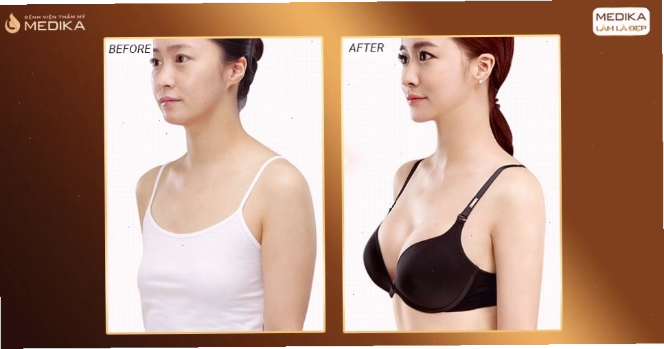 Trước và sau khi nâng ngực ở Medika có dùng phương pháp Massage
