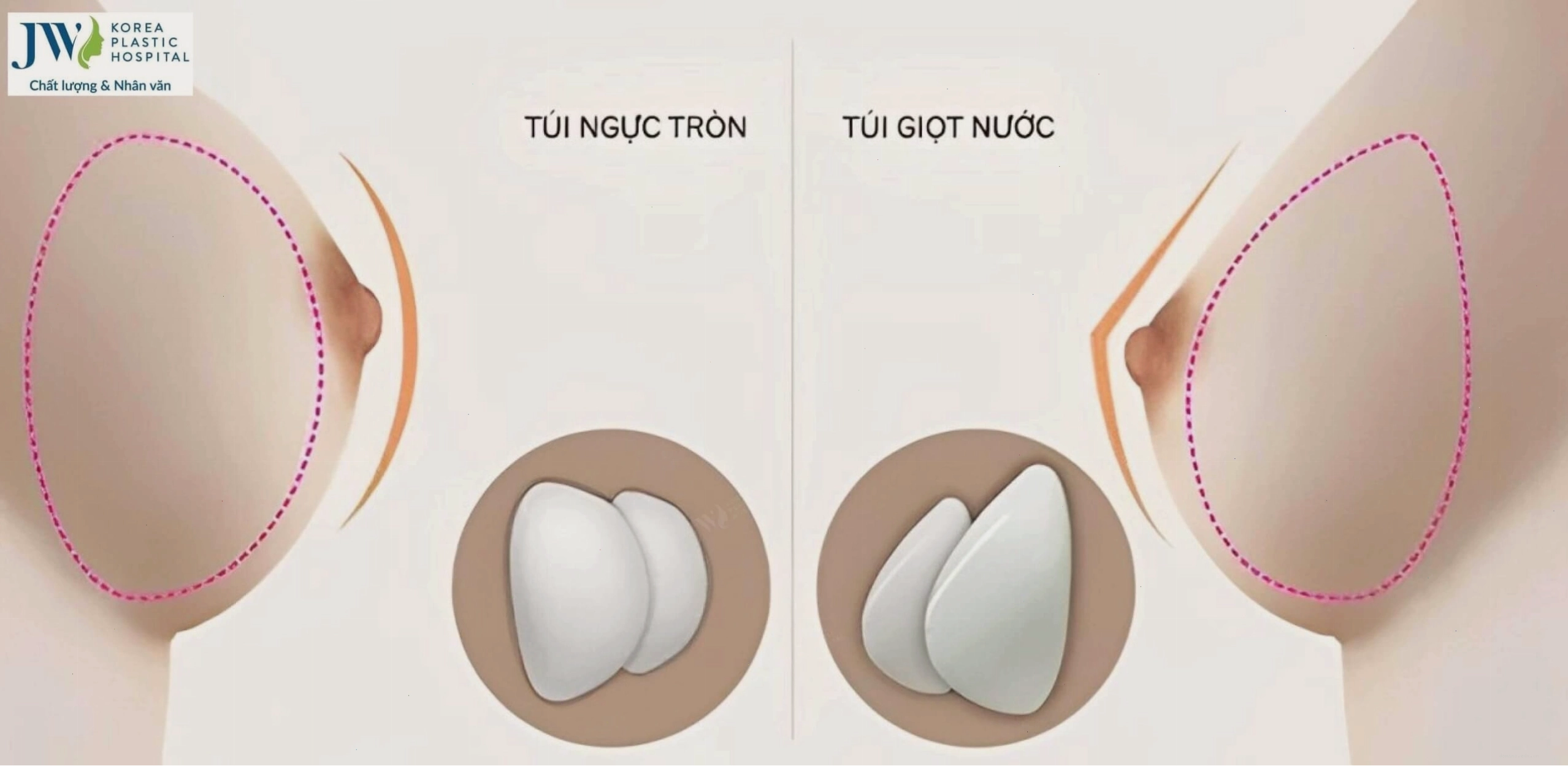 Tư vấn chọn size túi ngực phù hợp với từng dáng người