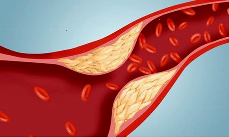 Viên giảm cân Slim Body hỗ trợ điều trị mỡ máu cao