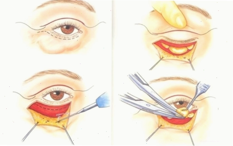 Xóa đường rãnh mắt bằng phẫu thuật là phương pháp triệt tiêu nếp nhăn, rãnh lệ hiệu quả vĩnh viễn