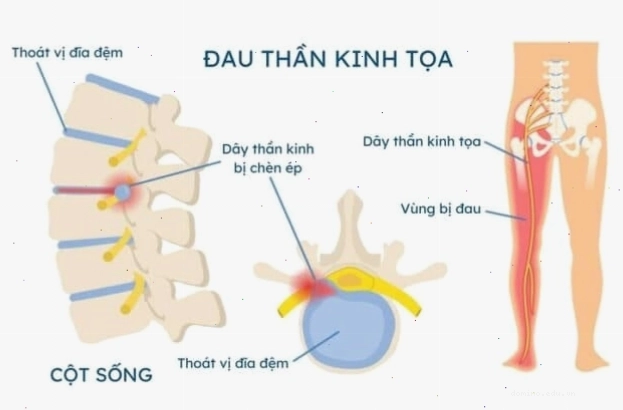 Yoga chữa đau dây thần kinh tọa, cải thiện triệu chứng bệnh với tư thế cây cầu